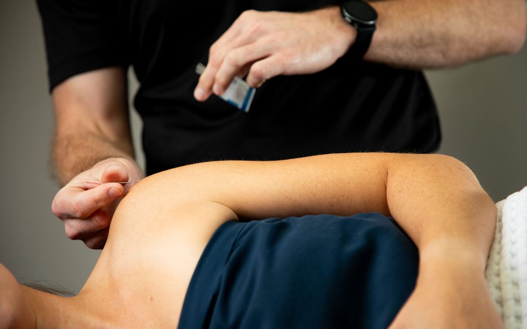 What Is Dry Needling and How Does it Help Physio Patients? 