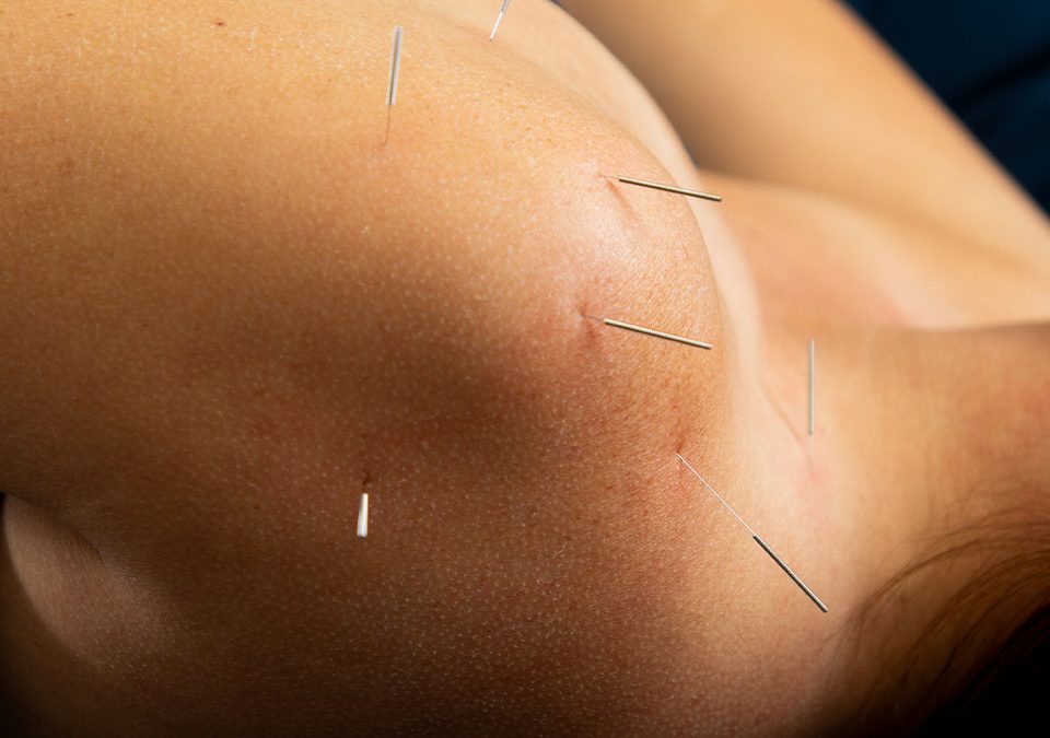 How Acupuncture Improves Sleep: Treat Insomnia & Sleep Apnea