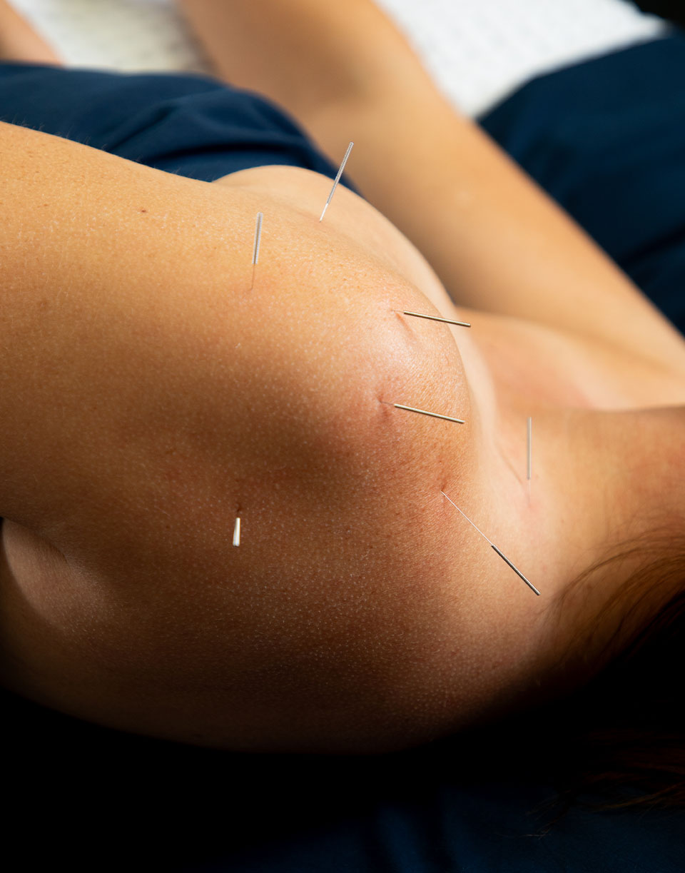 How Acupuncture Improves Sleep: Treat Insomnia & Sleep Apnea